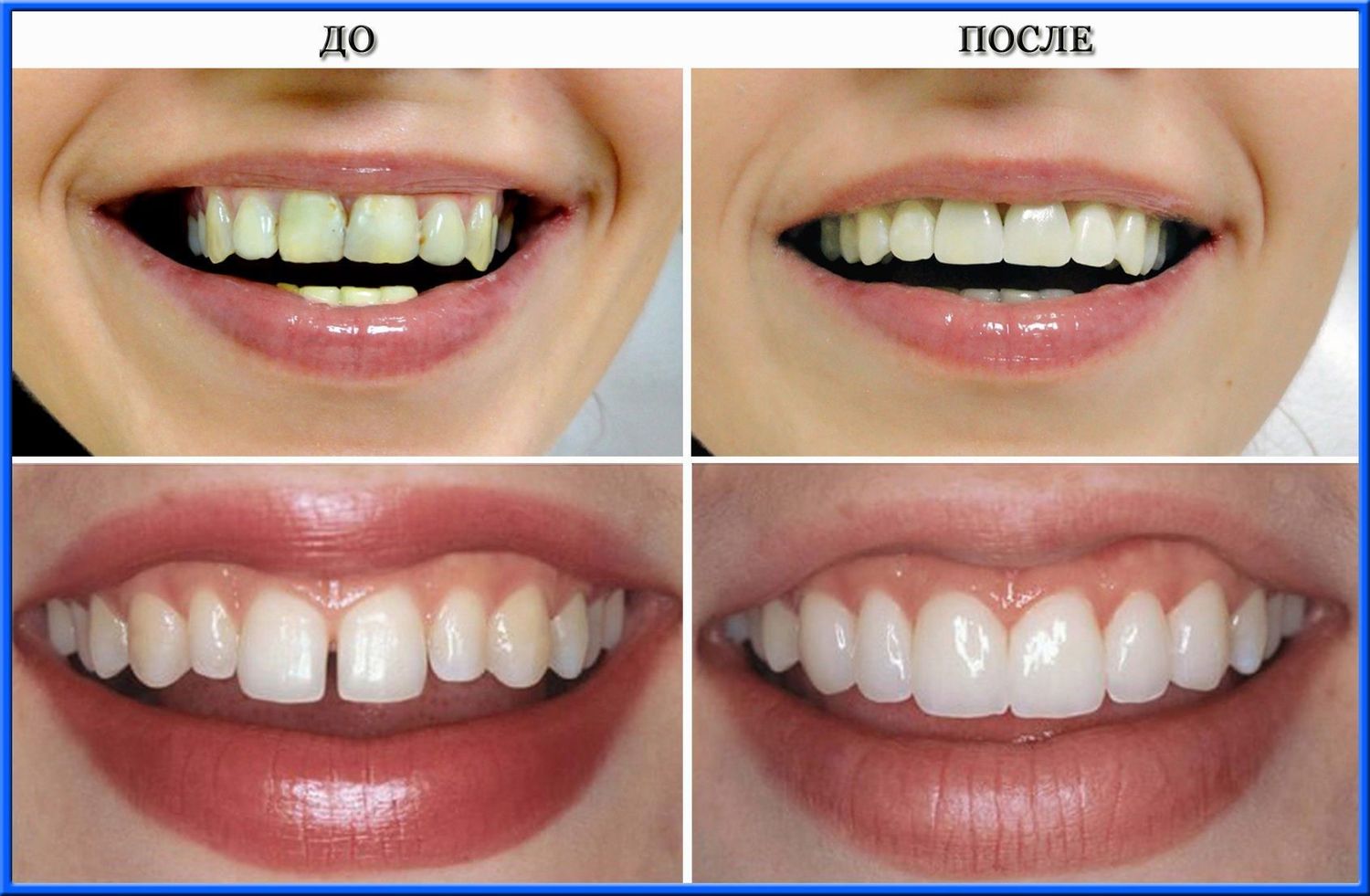 Натуральные Фото реставрации зубов до и после | Екатеринбург